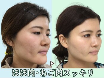 ナチュラルビューティーフェイス 横浜(NBF)/歪みを整えてキレイに/横浜小顔