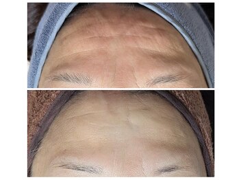 エボルブ 四条烏丸店(EVOLVE)/額シワ肌改善！