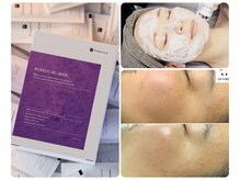 エスボーテ(sbeaute)の雰囲気（プラズマ×高濃度炭酸導入/ニキビ肌/アクネ菌殺菌/くすみ/美白）