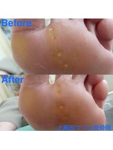 上高田つつじ整体院/魚の目ケア　施術例