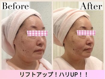 アンジェリカ(Angelica)/ハリ弾力UP！リフトアップ◎