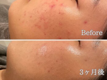 ポポラス(POPOLUS)/ニキビケア3回