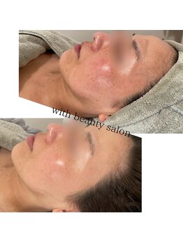 ウィズ(with)/REVIハーブピーリング×白玉WAX