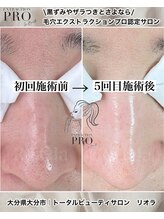 ニュートラル(neutral)/毛穴エクストラクションプロ大分