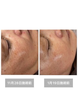 雪中花ナルシサス(narcisse)/たるみ・毛穴・くすみの原因改善