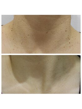 トラット エステアンドアイズ(tratto)/50代　お客様症例写真