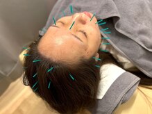 ラナスサッポロ(RUNUS SAPPORO)/【美容鍼】