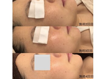 トータルビューティーサロン ププ(PuPu)/バクテリウムピール