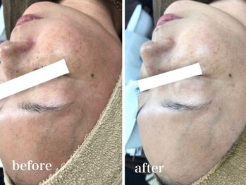 イリゼ(iriser)/ハーブピーリングBeforeAfter