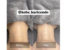 ハリシェンド/WiQOピール