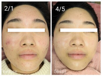 ラミーユ(La Miu)/ハーブピーリング5回目の変化