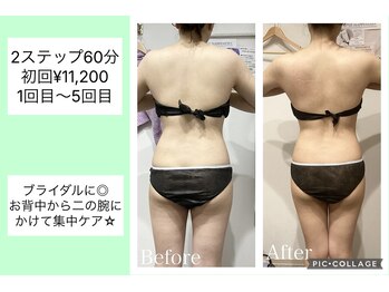 ハピネス(HAPPINESS)/背中、二の腕　1～5回目