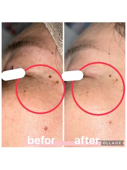 プリマ 大津店(PRIMA)/目元のシワケアはプラズマで★