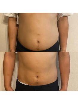 ビトタン 倉敷本店(+美to鍛)/男性のビール腹にも電磁パルス