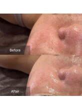 サロンツキ(salon tuki)/【お客様症例】最新光フォト1回