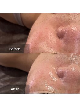 サロンツキ(salon tuki)/【お客様症例】最新光フォト1回