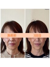 リフェイスフサエ(ReFace Fusae)/お顔の変化