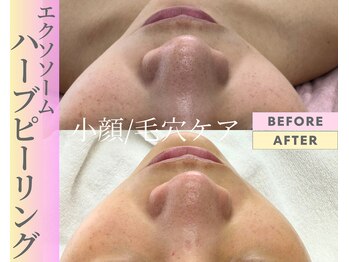 Cスキンケアクリニック 麻布店/ハーブピーリングBeforeAfter