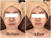 スペチアーレ 夙川/小顔効果、たるみ改善などに