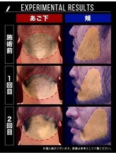 RBL ゆめタウンサンピアン熊本店/メンズ脱毛/ヒゲ脱毛施術2回目