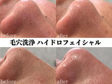 シャイン(SHINE)/毛穴洗浄ビフォーアフター