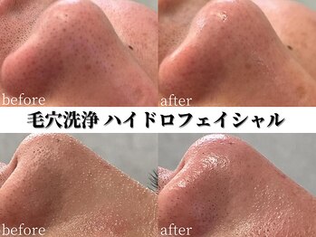 シャイン(SHINE)/毛穴洗浄ビフォーアフター