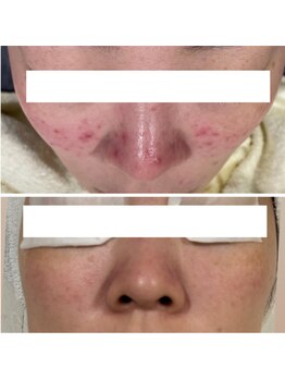 ハクビューティー(HAKU BEAUTY)/赤ら顔ケア