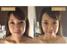 モモスパ(MOMOspa.)/頭蓋骨小顔矯正ビフォアフター