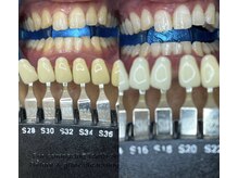 トウキョウスワーズ 池袋店(TOKYO SWRS)/#ホワイトニング #池袋 #渋谷