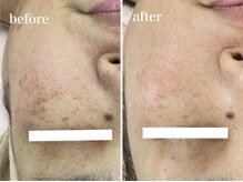 イリゼ(iriser)/ハーブピーリングBeforeAfter