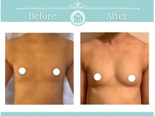 美人バスト 本厚木店/バストアップ◇症例◇