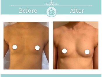 美人バスト 本厚木店/バストアップ◇症例◇