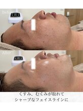 シロ(silo)/男性だって小顔に◎