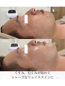 シロ(silo)/男性だって小顔に◎