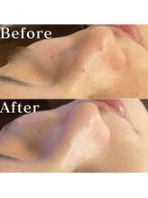 ミニョスキンラボ/W幹細胞ハーブピーリング3回