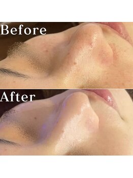 ミニョスキンラボ/W幹細胞ハーブピーリング3回