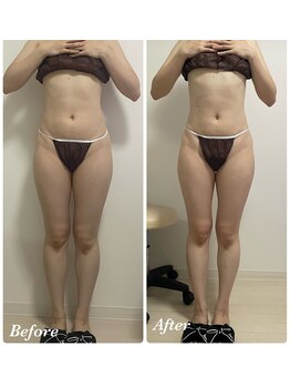 リュクス(LUXE)/20代足の浮腫と太さでお悩み