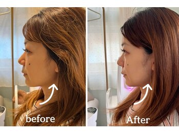 ミラ 中央林間(mira)/小顔　毛穴　ホワイトニング