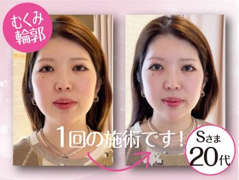 ネルジム 札幌店(NERU GYM)/むくみは一撃です！