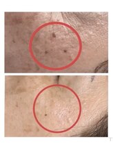 ザソースオブビューティ(The Source of Beauty)/ペンシル型マシンでシミケア