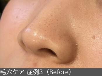 オアシスラグーン(OASIS LAGOON)/毛穴ケア(症例3:before)