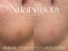 サロンドペオニー 川内店(salon de peony)の雰囲気（50代女性シミ施術例［毛穴/小顔/シミ/フェイシャル］）