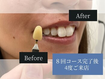 ホワイトニングカフェ 藤が丘店(WhiteningCafe)の写真/【藤が丘駅チカ♪】短期間で白い歯を目指せる…*。大切な瞬間に“白く輝く美しい歯を”