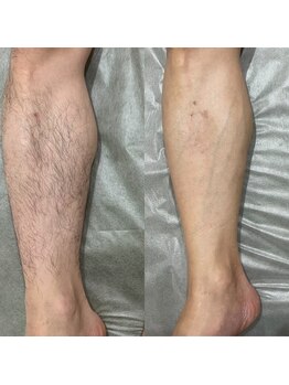 メンズサロンエヌエー(MEN'S SALON NA)/【足まるごと脱毛】