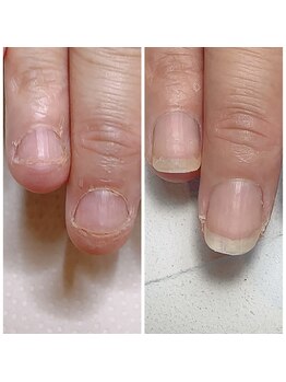 スマイルニコ(smile nico)/深爪矯正2ヶ月経過報告！