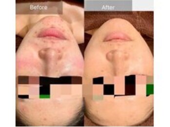 スキンベイビー 池袋店(Skin Baby)/幹細胞×ハーブピーリング