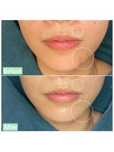 ちらちゅら/クリスティーナ【施術4回】経過