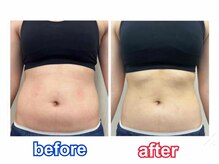 エルミューノ(elμno)/腹部ビフォーアフター