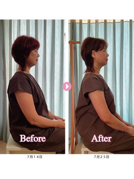 スピロソフィア/全身調整＋美容鍼