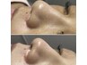 頑固な汚れをオフして、つるんと美肌!毛穴洗浄(全顔)¥6,200